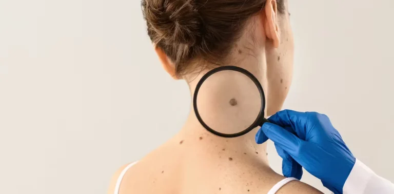 El melanoma: un cáncer duro de pelar